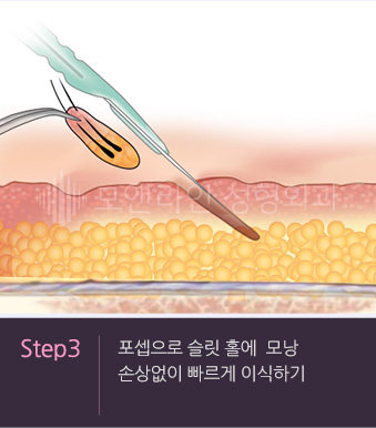 Step3. 포셉으로 슬릿 홀에  모낭 손상없이 빠르게 이식하기