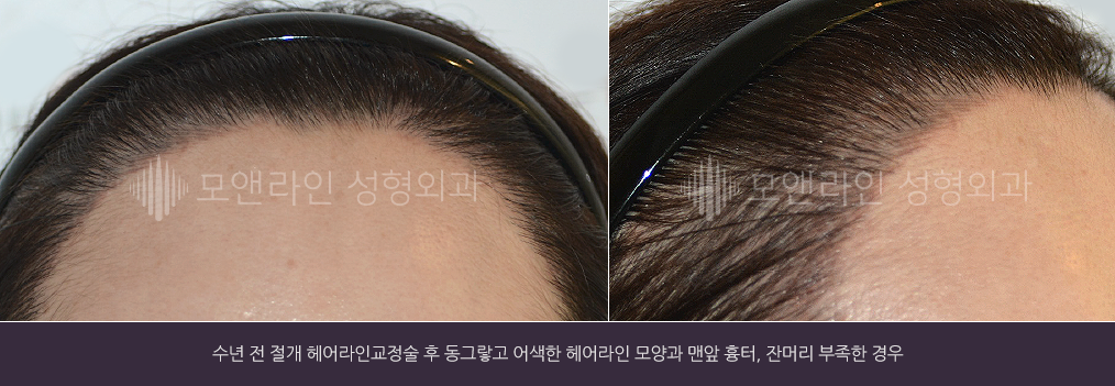 수년 전 절개 헤어라인교정술 후 동그랗고 어색한 헤어라인 모양과 맨앞 흉터, 잔머리 부족한 경우