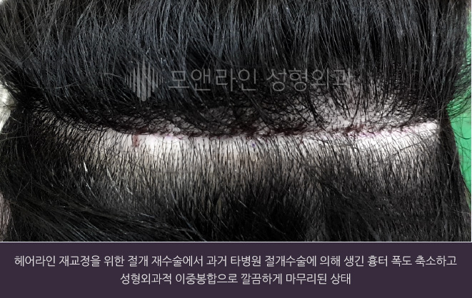 헤어라인 재교정을 위한 절개 재수술에서 과거 타병원 절개수술에 의해 생긴 흉터 폭도 축소하고 성형외과적 이중봉합으로 깔끔하게 마무리된 상태
