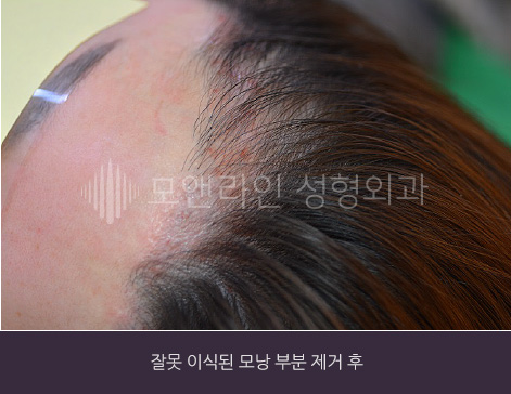 잘못 이식된 모낭 부분 제거 후