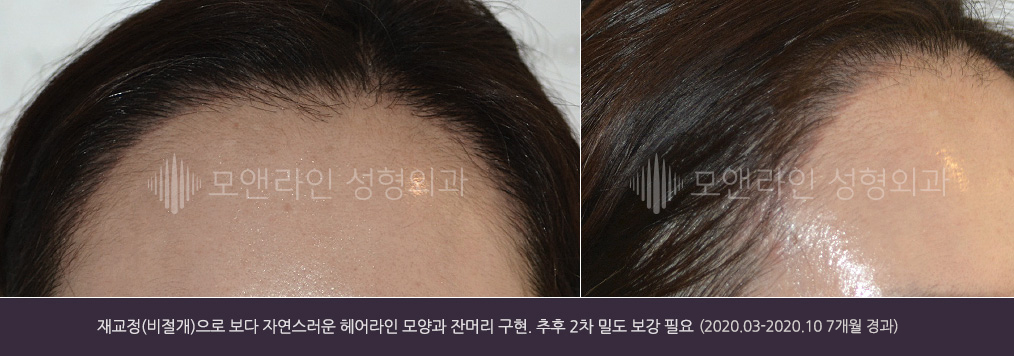 재교정(비절개)으로 보다 자연스러운 헤어라인 모양과 잔머리 구현. 추후 2차 밀도 보강 필요(2020.03-2020.10 7개월 경과)