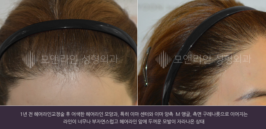 1년 전 헤어라인교정술 후 어색한 헤어라인 모양과, 특히 이마 센터와 이마 양측  M 앵글, 측면 구레나룻으로 이어지는 라인이 너무나 부자연스럽고 헤어라인 앞에 두꺼운 모발이 자라나온 상태