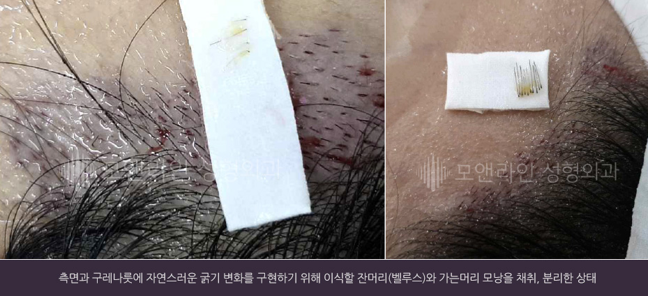 측면과 구레나룻에 자연스러운 굵기 변화를 구현하기 위해 이식할 잔머리(벨루스)와 가는머리 모낭을 채취, 분리한 상태