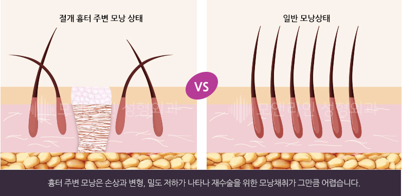 흉터 주변 모낭은 손상과 변형, 밀도 저하가 나타나 재수술을 위한 모낭채취가 그만큼 어렵습니다.