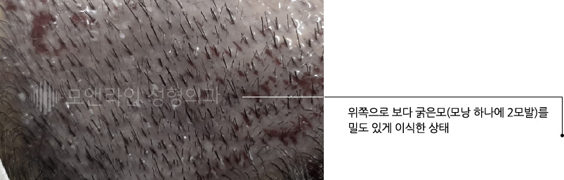 위쪽으로 보다 굵은모(모낭 하나에 2모발)를 밀도 있게 이식한 상태