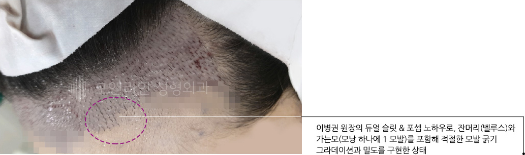 이병권 원장의 듀얼 슬릿 & 포셉 노하우로, 잔머리(벨루스)와 가는모(모낭 하나에 1 모발)를 포함해 적절한 모발 굵기 그라데이션과 밀도를 구현한 상태