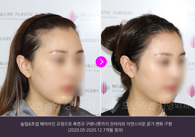 슬릿&포셉 헤어라인교정으로 측면과 구레나룻까지 잔머리와 자연스러운 굵기 변화 구현(2020.05-2020.12 7개월 경과)