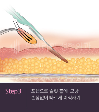 Step3. 포셉으로 슬릿 홀에  모낭 손상없이 빠르게 이식하기