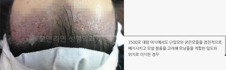 3500모 대량 이식에서도 단일모와 굵은모들을 점진적으로 배치시키고 모발 볼륨을 고려해 모낭들을 적합한 밀도와 위치로 이식한 경우