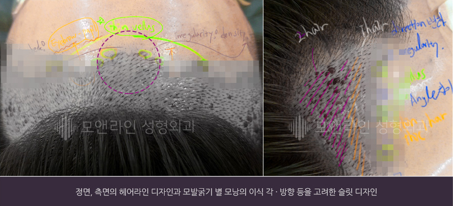 정면, 측면의 헤어라인 디자인과 모발굵기 별 모낭의 이식 각 · 방향 등을 고려한 슬릿 디자인