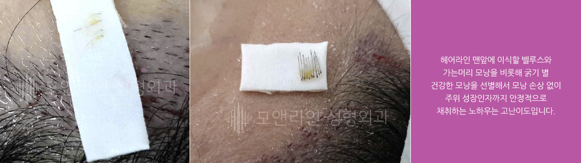 헤어라인 맨앞에 이식할 벨루스와 가는머리 모낭을 비롯해 굵기 별 건강한 모낭을 선별해서 모낭 손상 없이 주위 성장인자까지 안정적으로 채취하는 노하우는 고난이도입니다.
