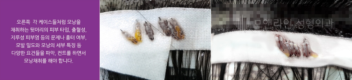 오른쪽 각 케이스들처럼 모낭을 채취하는 뒷머리의 피부 타입, 출혈성, 지루성 피부염 등의 문제나 흉터 여부, 모발 밀도와 모낭의 세부 특징 등 다양한 요건들을 파악, 컨트롤 하면서 모낭채취를 해야 합니다.