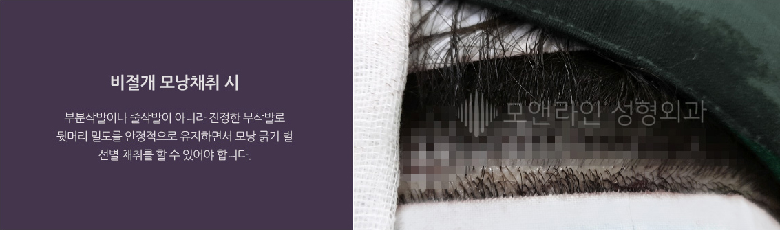 비절개 모낭채취 시 부분삭발이나 줄삭발이 아니라 진정한 무삭발로 뒷머리 밀도를 안정적으로 유지하면서 모낭 굵기 별 선별 채취를 할 수 있어야 합니다.