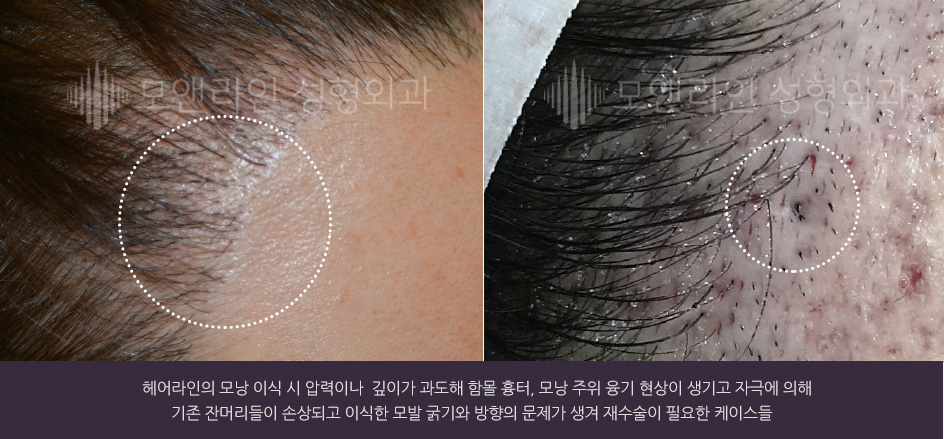 헤어라인의 모낭 이식 시 압력이나 깊이가 과도해 함몰 흉터, 모낭 주위 융기 현상이 생기고 자극에 의해 기존 잔머리들이 손상되고 이식한 모발 굵기와 방향의 문제가 생겨 재수술이 필요한 케이스들
