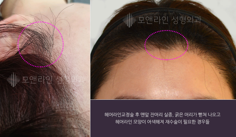 헤어라인교정술 후 맨앞 잔머리 실종, 굵은 머리가 뻗쳐 나오고 헤어라인 모양이 어색해져 재수술이 필요한 경우들