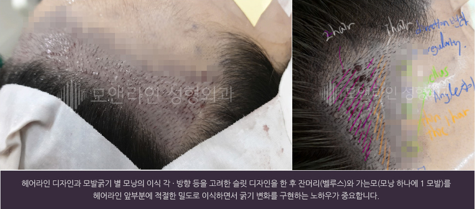헤어라인 디자인과 모발굵기 별 모낭의 이식 각 · 방향 등을 고려한 슬릿 디자인을 한 후 잔머리(벨루스)와 가는모(모낭 하나에 1 모발)를 헤어라인 앞부분에 적절한 밀도로 이식하면서 굵기 변화를 구현하는 노하우가 중요합니다.
