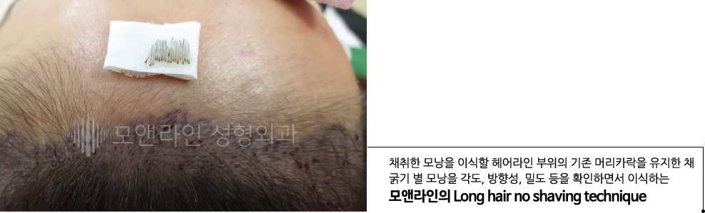 채취한 모낭을 이식할 헤어라인 부위의 기존 머리카락을 유지한 채 굵기 별 모낭을 각도, 방향성, 밀도 등을 확인하면서 이식하는 모앤라인의 Long hair no shaving technique