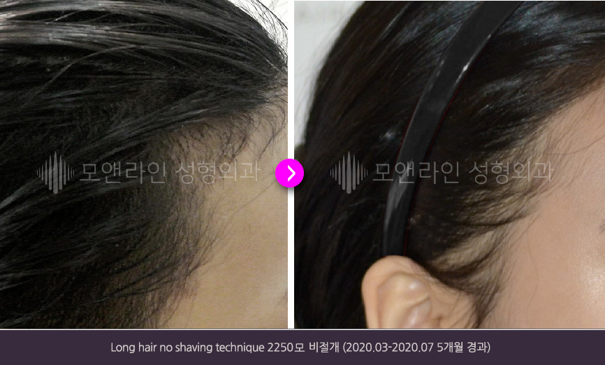 Long hair no shaving technique 2250모 비절개(2020.03-2020.07 5개월 경과)