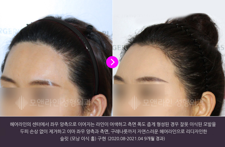 헤어라인의 센터에서 좌우 양측으로 이어지는 라인이 어색하고 측면 폭도 좁게 형성된 경우 잘못 이식된 모발을 두피 손상 없이 제거하고 이마 좌우 양측과 측면, 구레나룻까지 자연스러운 헤어라인으로 리디자인한 슬릿(모낭 이식 홀) 구현(2020.08-2021.04 9개월 경과)