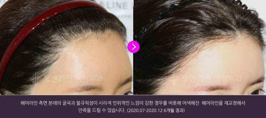 헤어라인 측면 본래의 굴곡과 불규칙성이 사라져 인위적인 느낌이 강한 경우를 비롯해 어색해진 헤어라인을 재교정해서 만족을 드릴 수 있습니다.(2020.07-2020.12 6개월 경과)