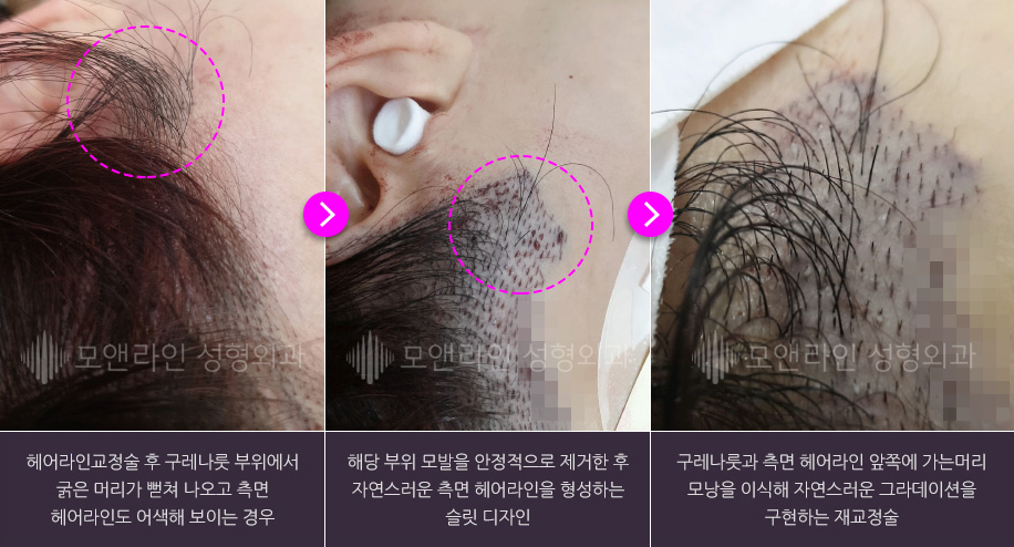 헤어라인교정술 후 구레나룻 부위에서 굵은 머리가 뻗쳐 나오고 측면 헤어라인도 어색해 보이는 경우 > 해당 부위 모발을 안정적으로 제거한 후 자연스러운 측면 헤어라인을 형성하는 슬릿 디자인 > 구레나룻과 측면 헤어라인 앞쪽에 가는머리 모낭을 이식해 자연스러운 그라데이션을 구현하는 재교정술