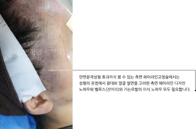 안면윤곽성형 효과까지 볼 수 있는 측면 헤어라인교정술에서는 성형의 관점에서 광대와 얼굴 옆면을 고려한 측면 헤어라인 디자인 노하우와 벨루스(잔머리)와 가는모발의 이식 노하우 모두 필요합니다.