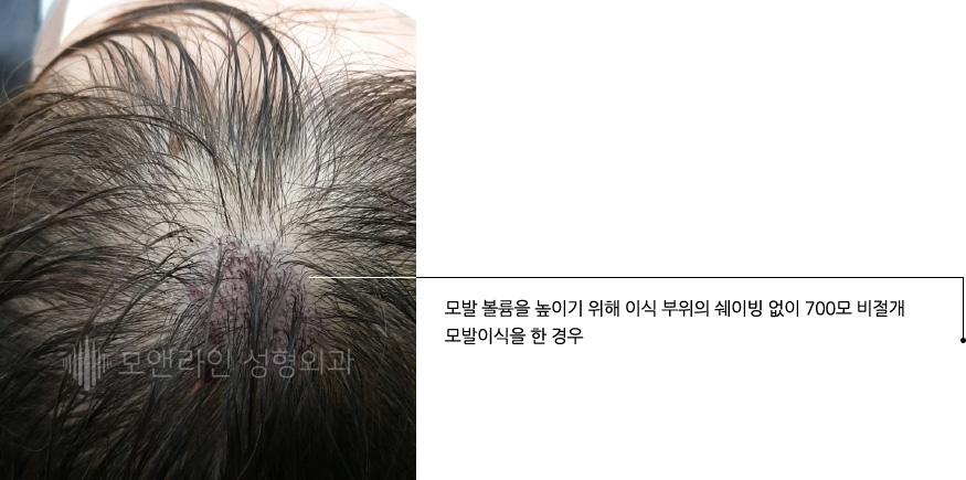 모발 볼륨을 높이기 위해 이식 부위의 쉐이빙 없이 700모 비절개 모발이식을 한 경우