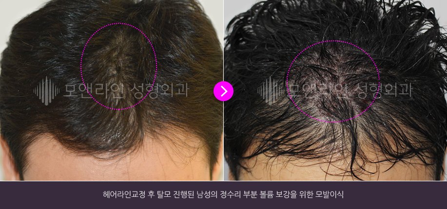 헤어라인교정 후 탈모 진행된 남성의 정수리 부분 볼륨 보강을 위한 모발이식