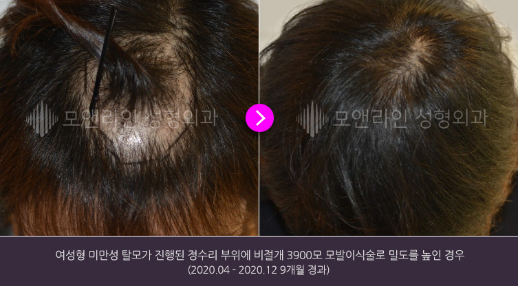 여성형 미만성 탈모가 진행된 정수리 부위에 비절개 3900모 모발이식술로 밀도를 높인 경우(2020.04 - 2020.12 9개월 경과)