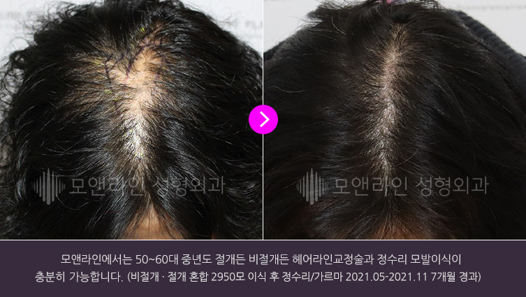 모앤라인에서는 50~60대 중년도 절개든 비절개든 헤어라인교정술과 정수리 모발이식이 충분히 가능합니다.(절개 모낭채취로 2750모 이식 후. 정수리/가르마 2021.05-2021.11 7개월 경과)