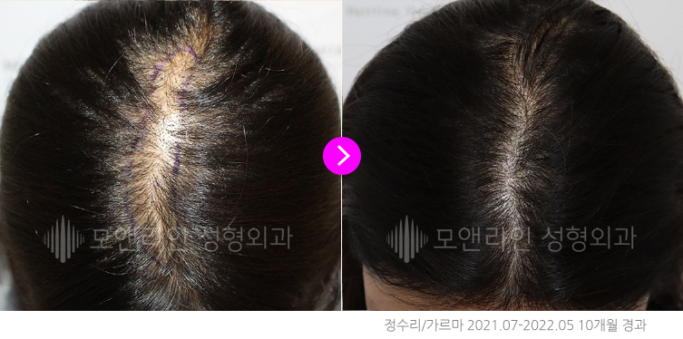 정수리/가르마 2021.07-2022.05 10개월 경과