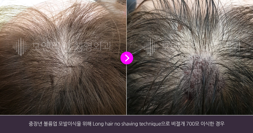 중장년 볼륨업 모발이식을 위해 Long hair no shaving technique으로 비절개 700모 이식한 경우