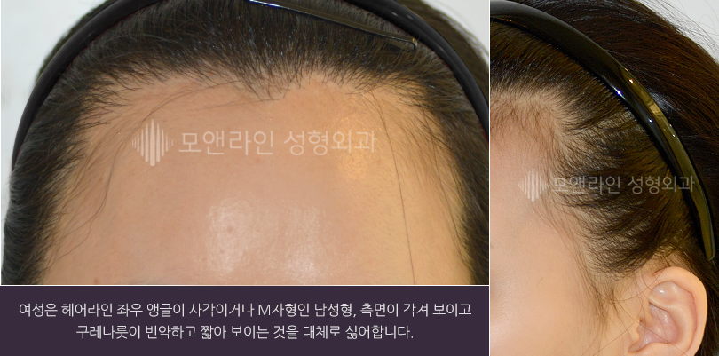 여성은 헤어라인 좌우 앵글이 사각이거나 M자형인 남성형, 측면이 각져 보이고 구레나룻이 빈약하고 짧아 보이는 것을 대체로 싫어합니다.