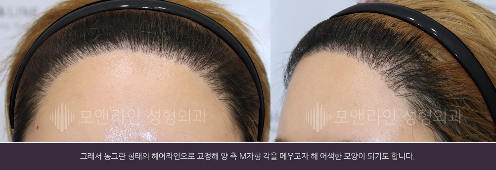 그래서 동그란 형태의 헤어라인으로 교정해 양 측 M자형 각을 메우고자 해 어색한 모양이 되기도 합니다.