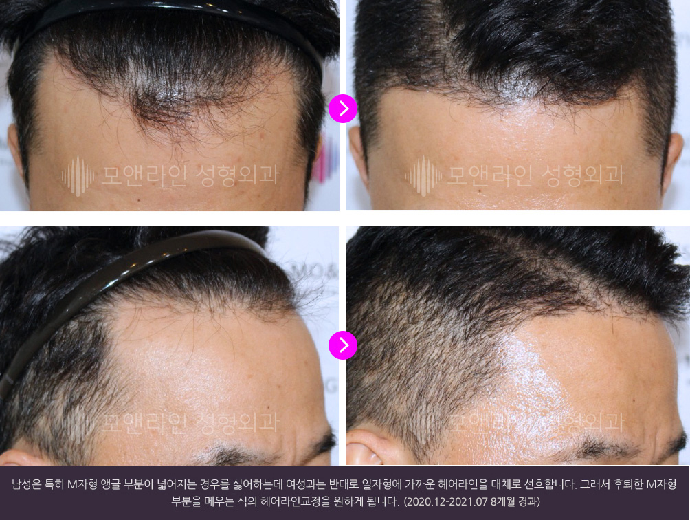 남성은 특히 M자형 앵글 부분이 넓어지는 경우를 싫어하는데 여성과는 반대로 일자형에 가까운 헤어라인을 대체로 선호합니다. 그래서 후퇴한 M자형 부분을 메우는 식의 헤어라인교정을 원하게 됩니다.(2020.12-2021.07 8개월 경과)