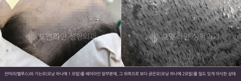 잔머리(벨루스)와 가는모(모낭 하나에 1 모발)를 헤어라인 앞부분에, 그 위쪽으로 보다 굵은모(모낭 하나에 2모발)를 밀도 있게 이식한 상태