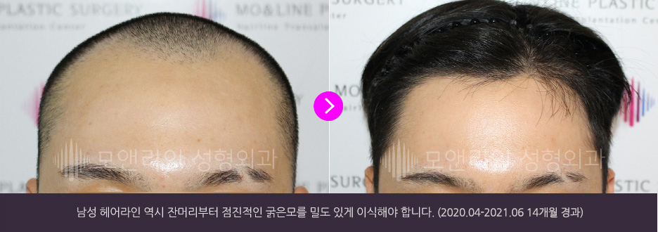 남성 헤어라인 역시 잔머리부터 점진적인 굵은모를 밀도 있게 이식해야 합니다.(2020.04-2021.06 14개월 경과)