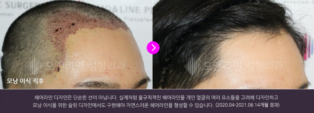 헤어라인 디자인은 단순한 선이 아닙니다. 실제처럼 불규칙적인 헤어라인을 개인 얼굴의 여러 요소들을 고려해 디자인하고 모낭 이식을 위한 슬릿 디자인에서도 구현해야 자연스러운 헤어라인을 형성할 수 있습니다.(2020.04-2021.06 14개월 경과)