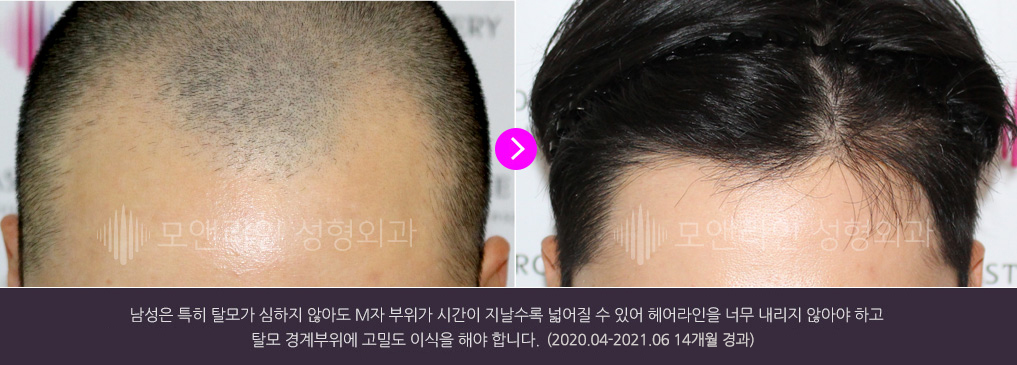 남성은 특히 탈모가 심하지 않아도 M자 부위가 시간이 지날수록 넓어질 수 있어 헤어라인을 너무 내리지 않아야 하고 탈모 경계부위에 고밀도 이식을 해야 합니다.(2020.04-2021.06 14개월 경과)