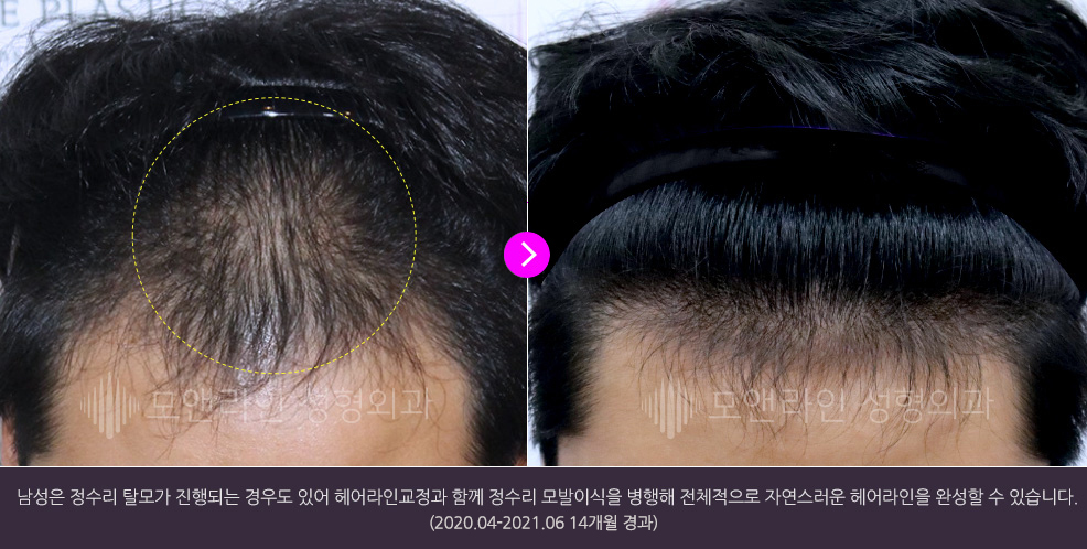 남성은 정수리 탈모가 진행되는 경우도 있어 헤어라인교정과 함께 정수리 모발이식을 병행해 전체적으로 자연스러운 헤어라인을 완성할 수 있습니다.(2020.04-2021.06 14개월 경과)