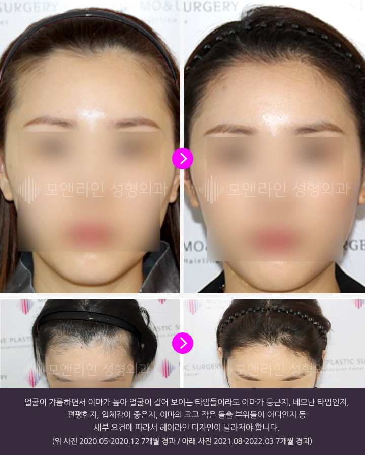얼굴이 갸름하면서 이마가 높아 얼굴이 길어 보이는 타입들이라도 이마가 둥근지, 네모난 타입인지, 편평한지, 입체감이 좋은지, 이마의 크고 작은 돌출 부위들이 어디인지 등 세부 요건에 따라서 헤어라인 디자인이 달라져야 합니다.(위 사진 2020.05-2020.12 7개월 경과 / 아래 사진 2021.08-2022.03 7개월 경과)
