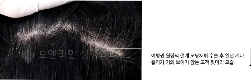 이병권 원장의 절개 모낭채취 수술 후 일년 지나 흉터가 거의 보이지 않는 고객 뒷머리 모습