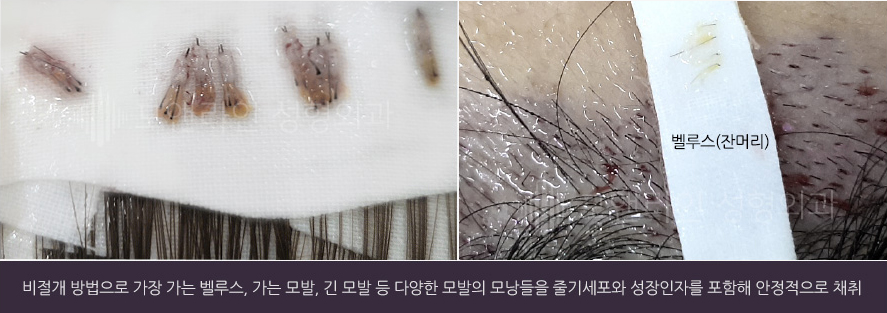 비절개 방법으로 가장 가는 벨루스, 가는 모발, 긴 모발 등 다양한 모발의 모낭들을 줄기세포와 성장인자를 포함해 안정적으로 채취