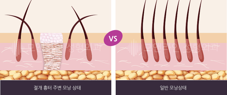 절개 흉터 주변 모낭 상태 VS 일반 모낭상태