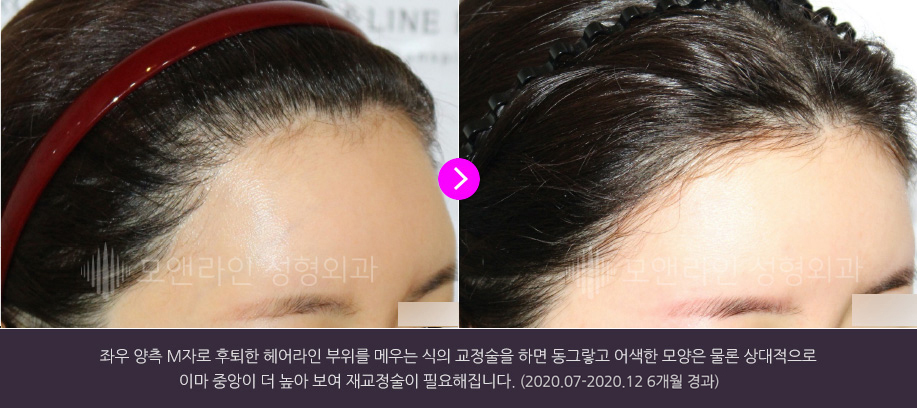 좌우 양측 M자로 후퇴한 헤어라인 부위를 메우는 식의 교정술을 하면 동그랗고 어색한 모양은 물론 상대적으로 이마 중앙이 더 높아 보여 재교정술이 필요해집니다.(2020.07-2020.12 6개월 경과)