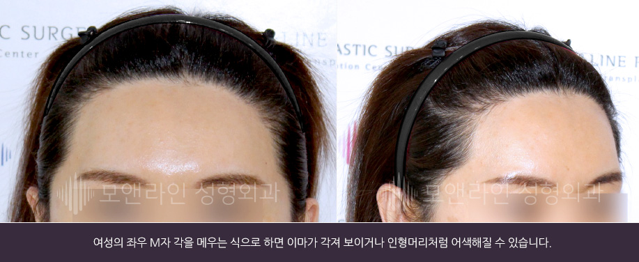 여성의 경우 헤어라인교정술 후 이마가 각져 보여 남성적인 느낌이 나지 않도록 해야 합니다.