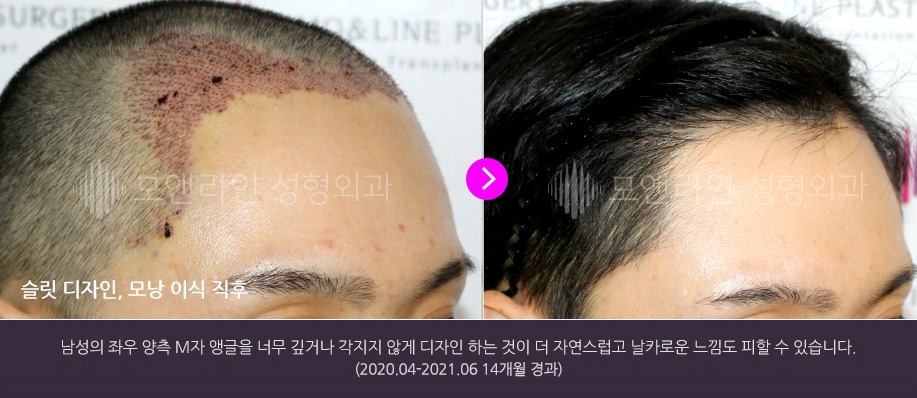 남성의 좌우 양측 M자 앵글을 너무 깊거나 각지지 않게 디자인 하는 것이 더 자연스럽고 날카로운 느낌도 피할 수 있습니다.(2020.04-2021.06 14개월 경과)