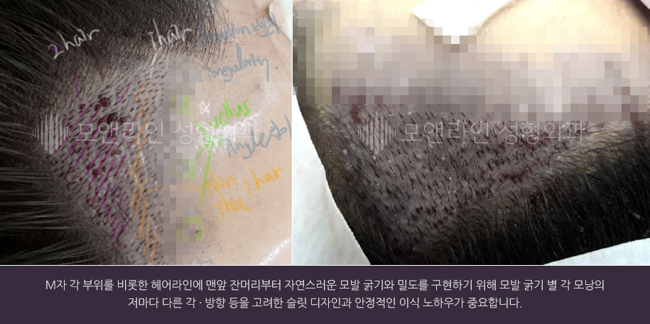 M자 각 부위를 비롯한 헤어라인에 맨앞 잔머리부터 자연스러운 모발 굵기와 밀도를 구현하기 위해 모발 굵기 별 각 모낭의 저마다 다른 각 · 방향 등을 고려한 슬릿 디자인과 안정적인 이식 노하우가 중요합니다.