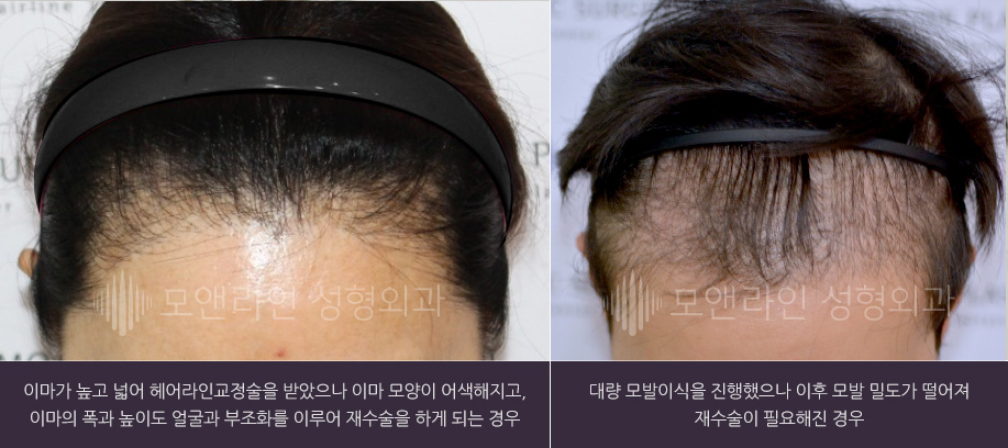 이마가 높고 넓어 헤어라인교정술을 받았으나 이마 모양이 어색해지고, 이마의 폭과 높이도 얼굴과 부조화를 이루어 재수술을 하게 되는 경우 / 대량 모발이식을 진행했으나 이후 모발 밀도가 떨어져 재수술이 필요해진 경우