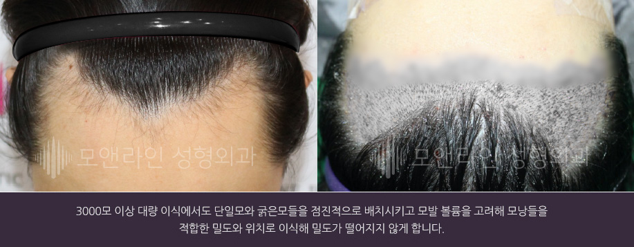 3000모 이상 대량 이식에서도 단일모와 굵은모들을 점진적으로 배치시키고 모발 볼륨을 고려해 모낭들을 적합한 밀도와 위치로 이식해 밀도가 떨어지지 않게 합니다.